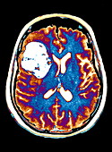Brain cancer,MRI