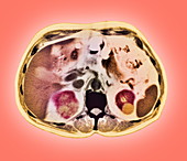 Kidney tumour,CT scan