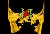 Pituitary gland tumour,3-D CT scan