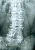 Secondary bone cancer,X-ray