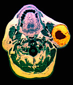 Salivary gland tumour,head MRI scan