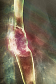 Oesophagus cancer,X-ray