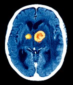 Brain cancer,CT scan