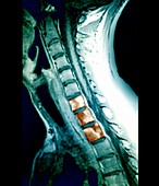 Bone cancer,neck MRI scan