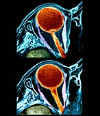 Eye cancer,MRI scan