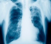 Lung cancer,X-ray