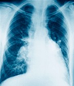 Throat cancer,X-ray