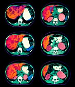 Liver cancer,CT scans