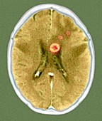 Secondary brain cancers,CT scan