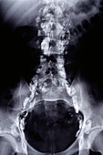 Hodgkin's disease,lymphangiogram