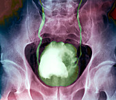 Bladder cancer,X-ray