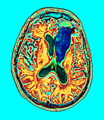 Brain cancer treatment,MRI scan