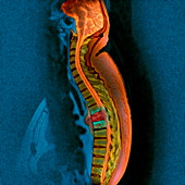 Bone cancer,MRI