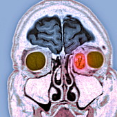 Secondary cancer,MRI