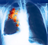 Lung cancer,X-ray