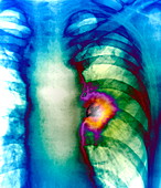 Lung cancer,X-ray