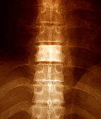 Hodgkin's lymphoma,X-ray