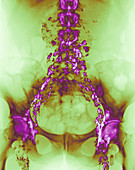 Hodgkin's lymphoma,X-ray