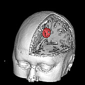 Brain tumour,3-D MRI scan