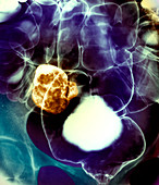 Colon cancer,barium X-ray