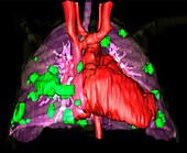 Secondary lung cancers,3D MRI scan