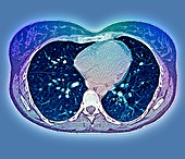 Secondary lung cancer,CT scan