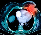 Breast cancer,CT scan