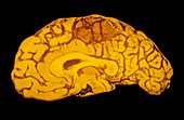 Specimen human brain showing haemorrhage