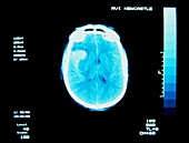 X-ray tomography scan of brain showing haemorrhage