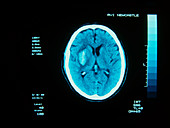 CT scan of cerebral (intracranial) haemorrhage