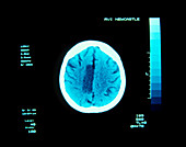 CT brain scan showing cerebral infarction - stroke