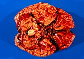 Subarachnoid haemorrhage from ruptured aneurysm