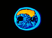 Coloured CT scan showing a cerebral infarction