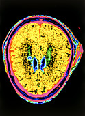 Coloured CT scan of an extradural haemorrhage