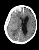 CT scan showing a subdural brain haemorrhage