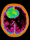 CT scan: brain haemorrhage from cerebral aneurysm