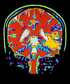 Coloured MRI scan of the brain after a stroke