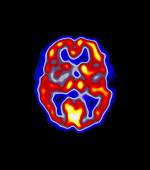 Coloured PET scan of the brain of a stroke patient