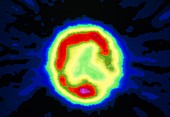 Coloured gamma scan of brain after stroke