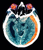 Cerebral haemorrhage,CT scan