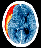 Brain haemorrhage,CT scan