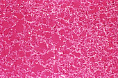 Blood vessel tumour,light micrograph