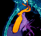 Abnormal clotting,CT scan