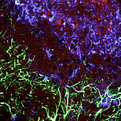 Damaged brain tissue,light micrograph
