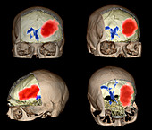 Brain haemorrhage,CT scans