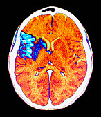 Stroke,CT brain scan