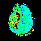 Stroke,fMRI scan
