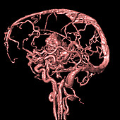 Brain arteriovenous malformation,MRA