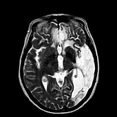 Haemorrhagic stroke damage,MRI scan