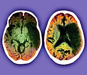 Stroke,CT brain scans